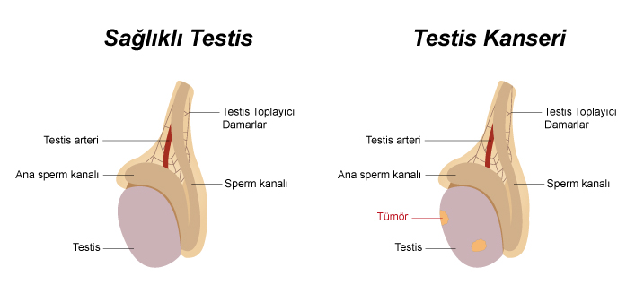 testis kanseri